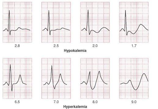 Potassium Related ECG changes